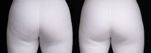 QWO results in NYC at JUVA Skin & Laser Center