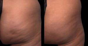 QWO results in NYC at JUVA Skin & Laser Center