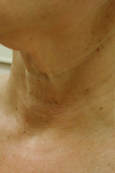 Neck Rejuvenation Before & After Gallery - Patient 49967497 - Image 1