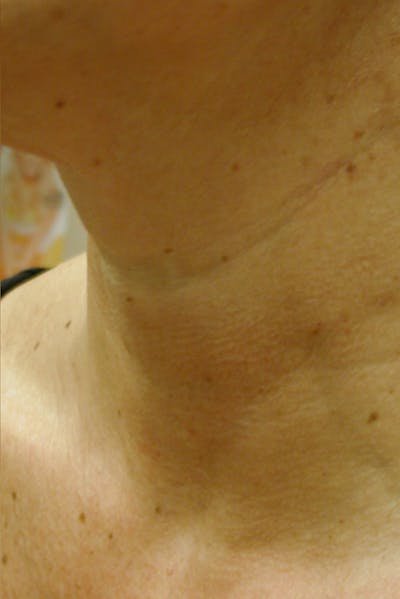 Neck Rejuvenation Before & After Gallery - Patient 49967497 - Image 2