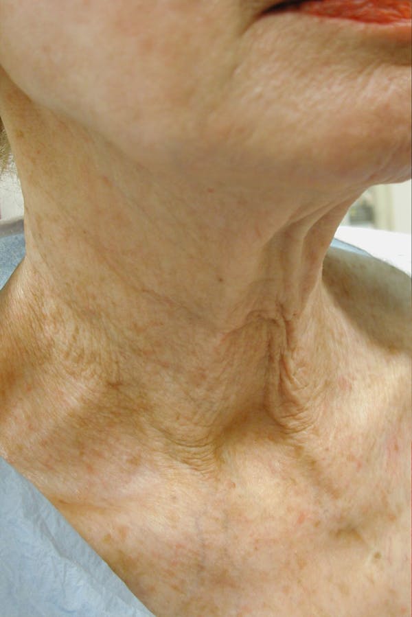 Neck Rejuvenation Before & After Gallery - Patient 49967496 - Image 1