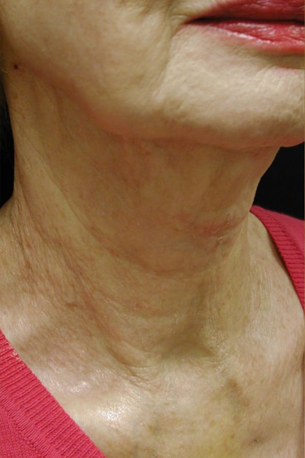 Neck Rejuvenation Before & After Gallery - Patient 49967496 - Image 2