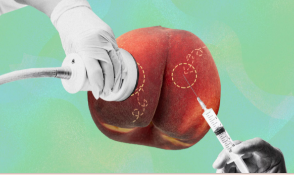 JUVA Skin & Laser Center Blog | Dr. Bruce Katz is featured in an article in Shape entitled What Does a Non-Surgical Butt Lift Entail, Exactly?