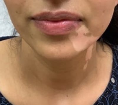 Vitiligo Before & After Gallery - Patient 132851393 - Image 1