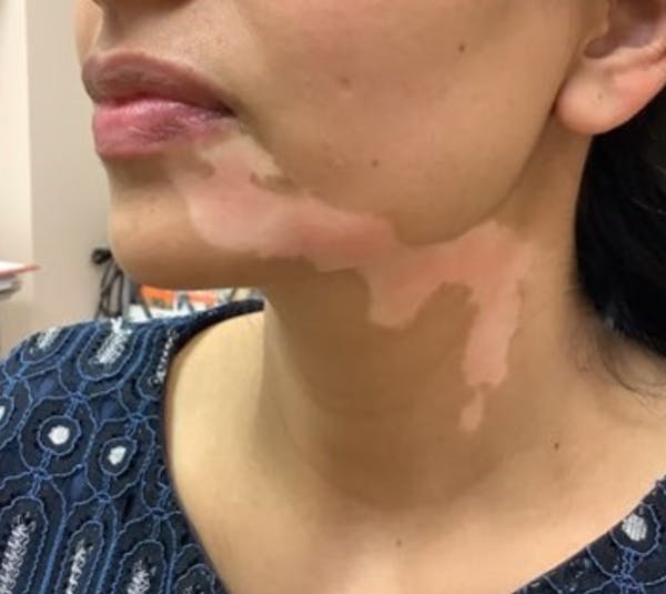 Vitiligo Before & After Gallery - Patient 132851393 - Image 3