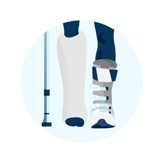 Illustration of broken leg in cast