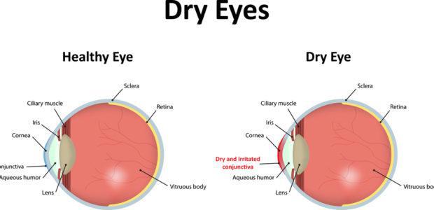 Beverly Hills Ophthalmology Blog | Not a Dry Eye in the house!