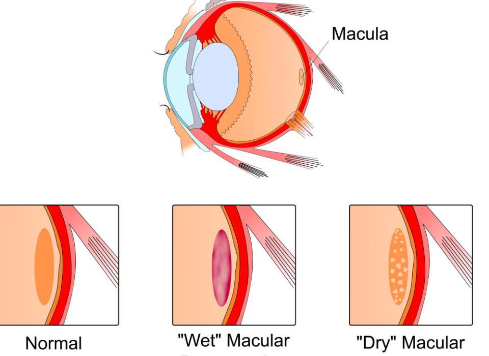 Beverly Hills Institute of Ophthalmology Blog | Age-Related Macular Degeneration