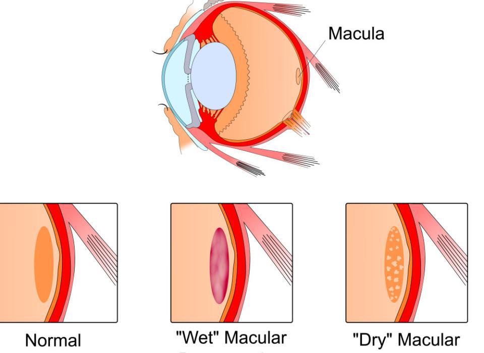 Beverly Hills Ophthalmology Blog | Age-Related Macular Degeneration