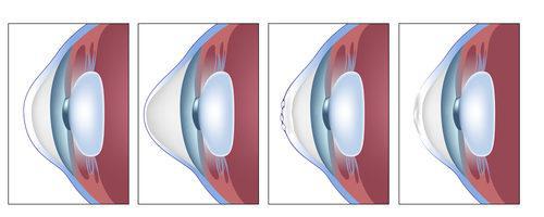 Beverly Hills Ophthalmology Blog | What to Know About Keratoconus