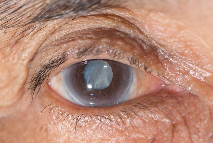 Beverly Hills Institute of Ophthalmology Blog | Treating Glaucoma with a Trabeculectomy