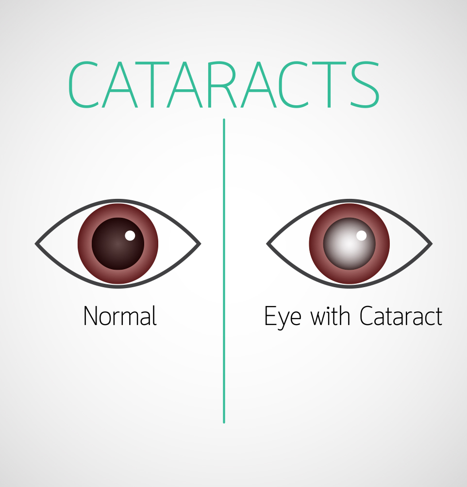 2-D image of how cataract surgery works