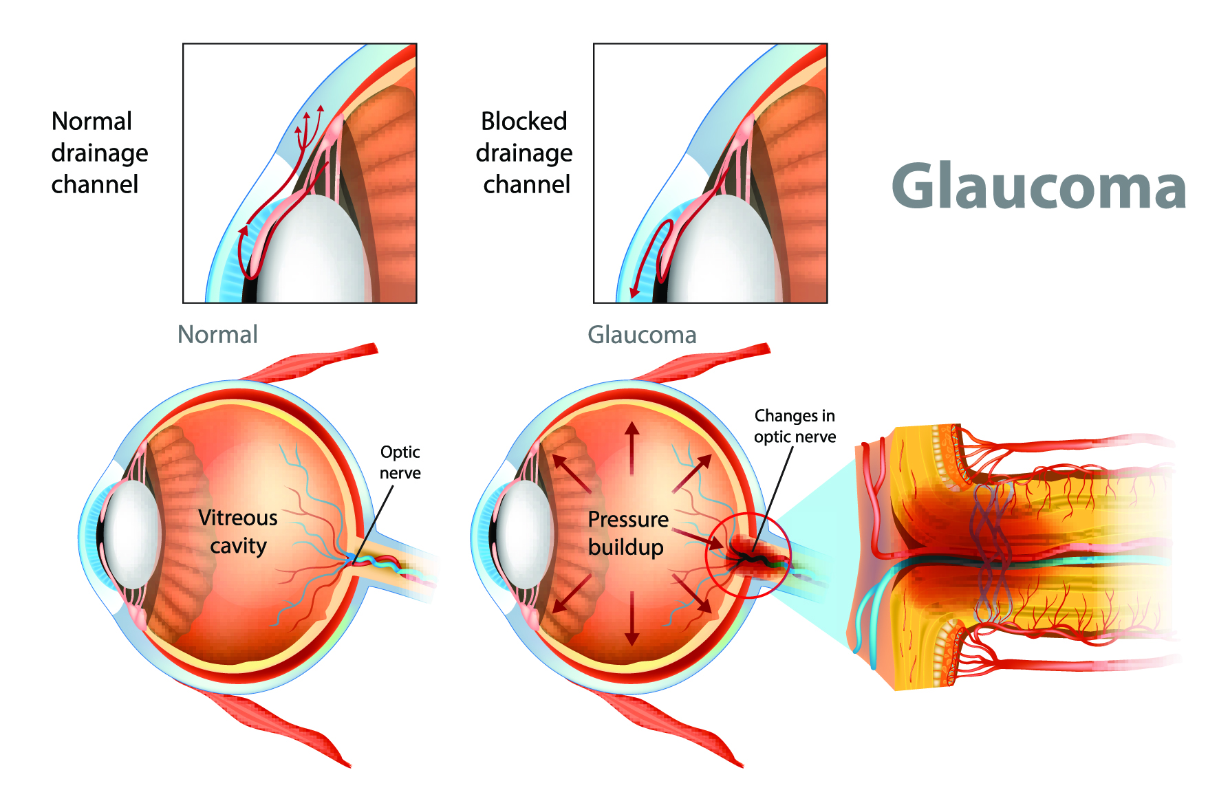 computer generated image of how a glaucoma treatment works