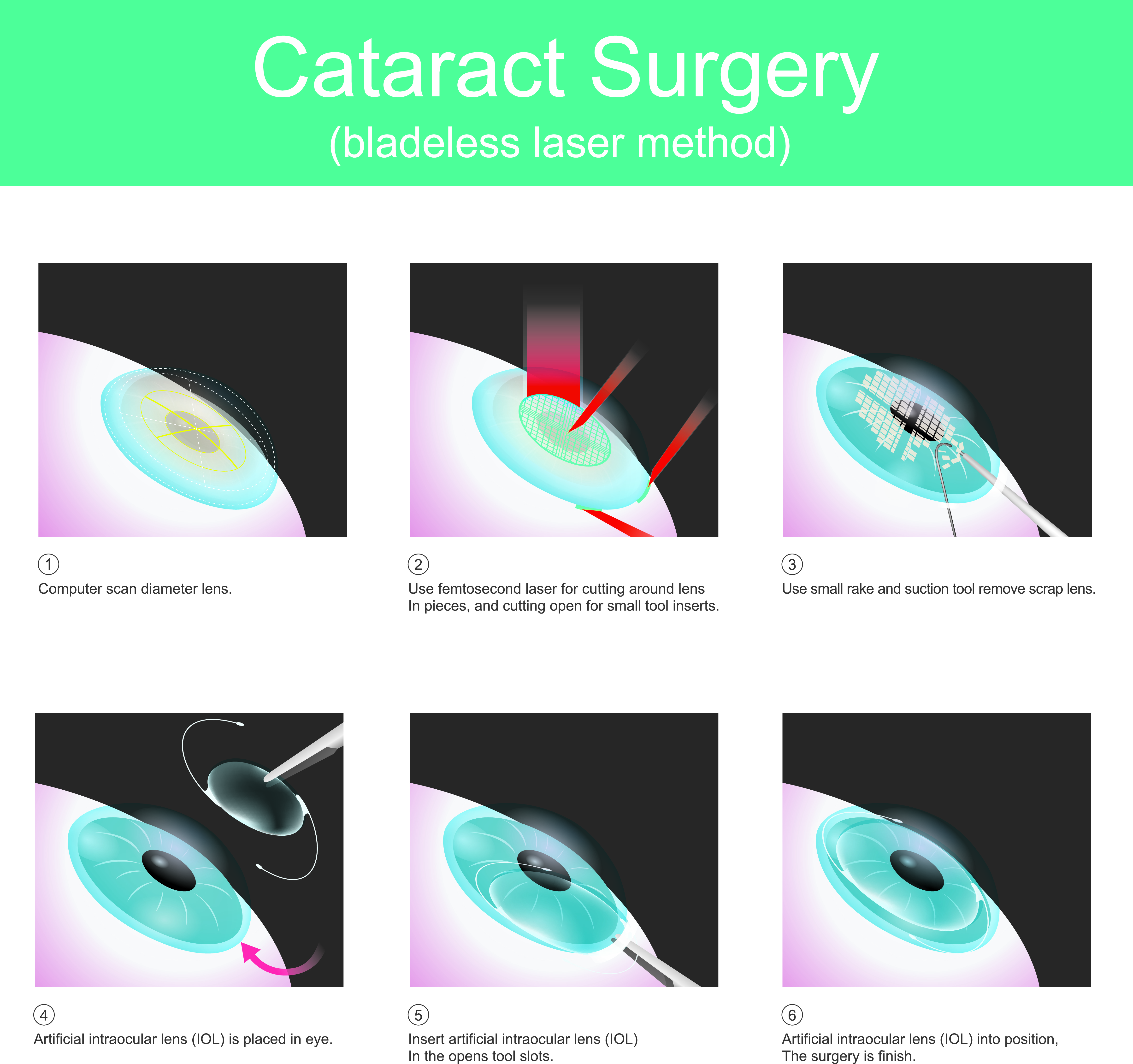 image of how a laser cataract surgery is performed