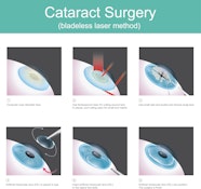 Laser Cataract Surgery In Torrance CA Laser Cataract Surgery In 