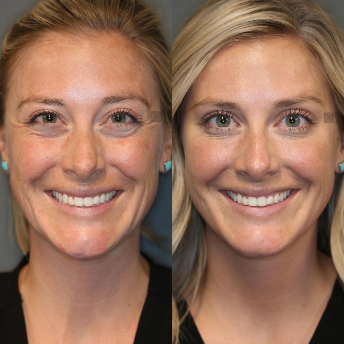 Before and after wrinkle treatment
