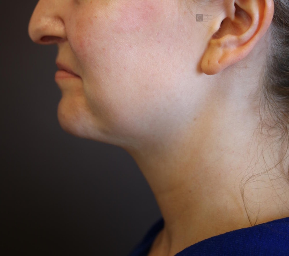 Before and After Structural Jawline Contouring