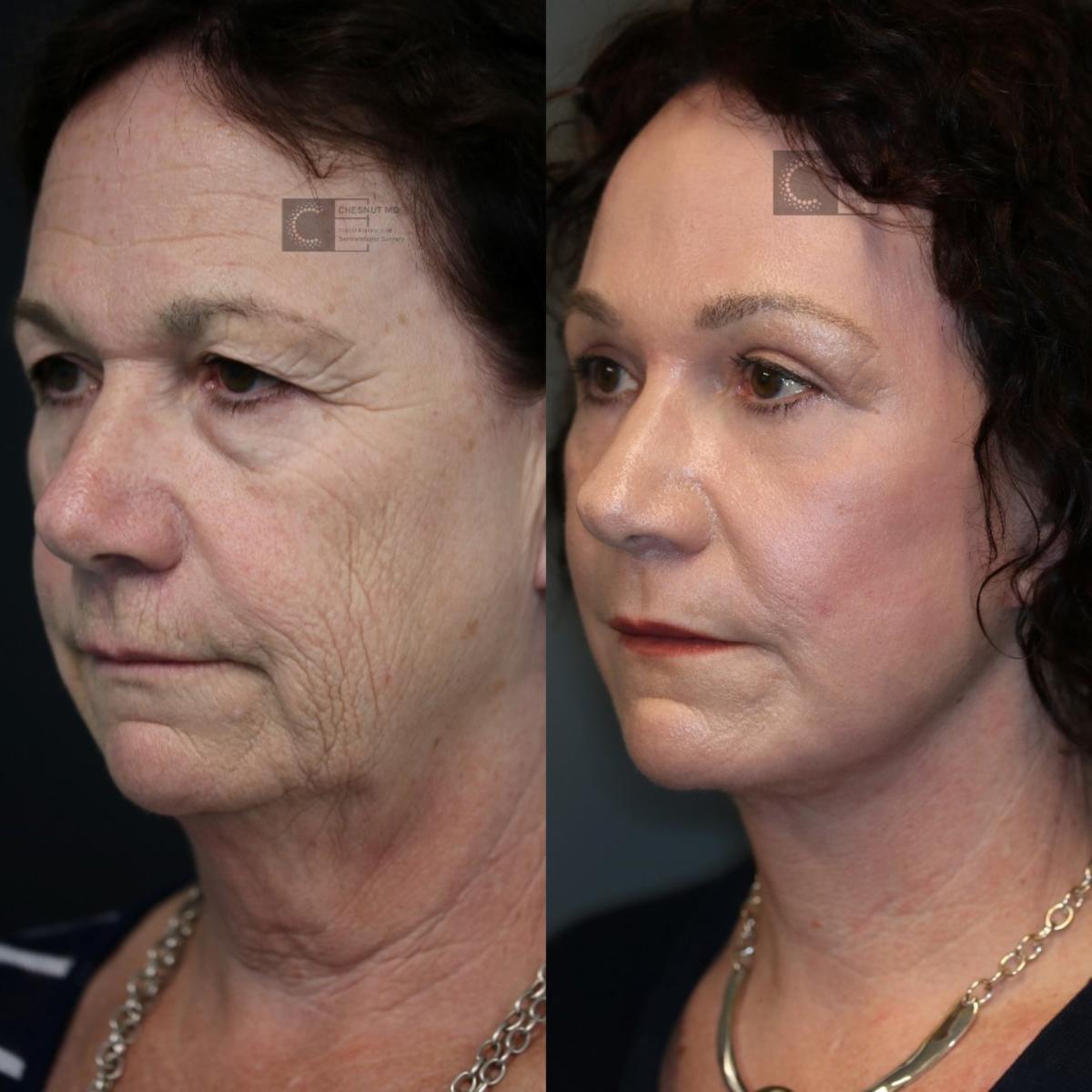 Before and after laser skin resurfacing