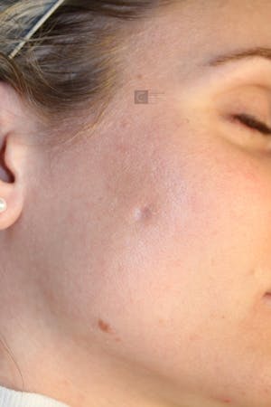 Before and after scar treatment