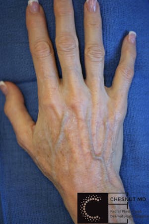 Before and after hand treatment
