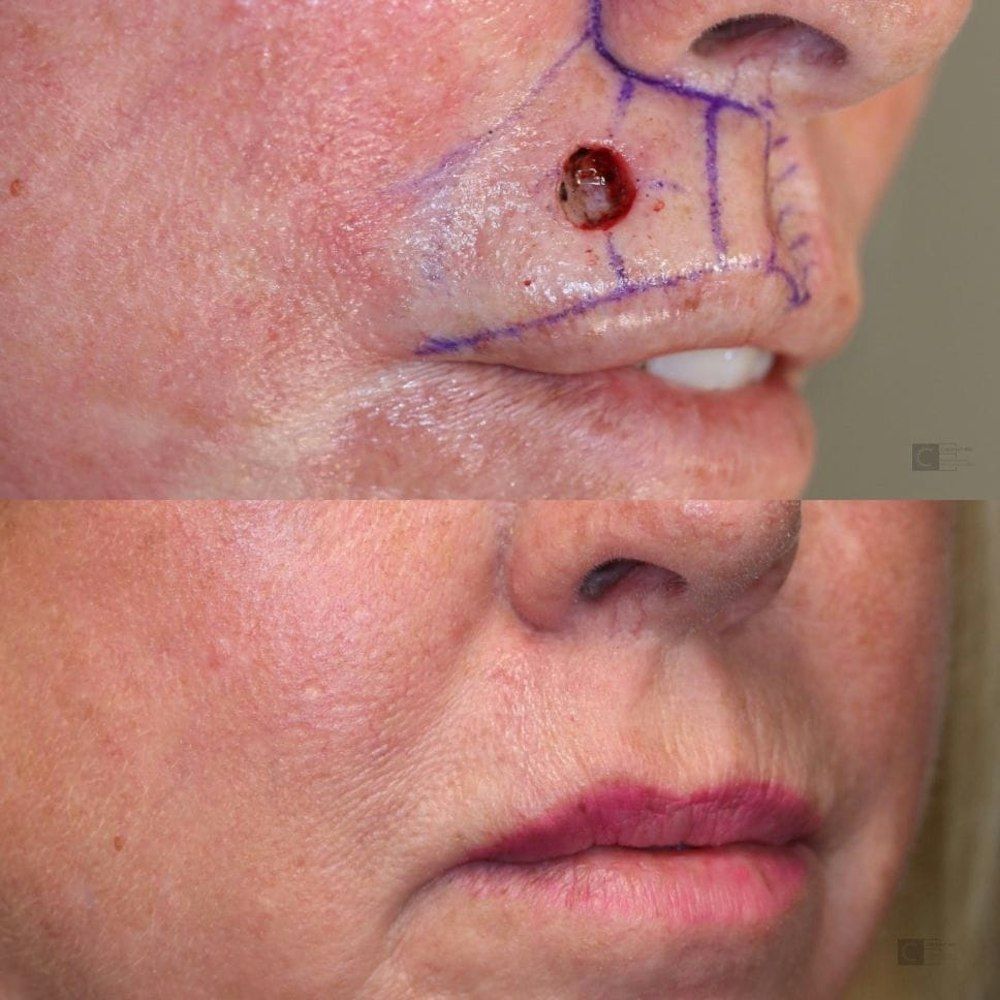 Before and After Reconstruction & Mohs Surgery