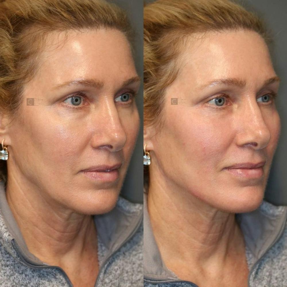 Dermal Fillers Before & After Gallery - Patient 8560372 - Image 1