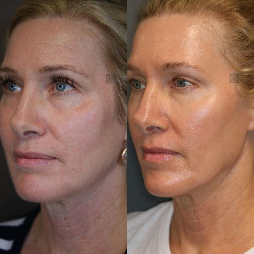 Dermal Fillers Before & After Gallery - Patient 8560372 - Image 2