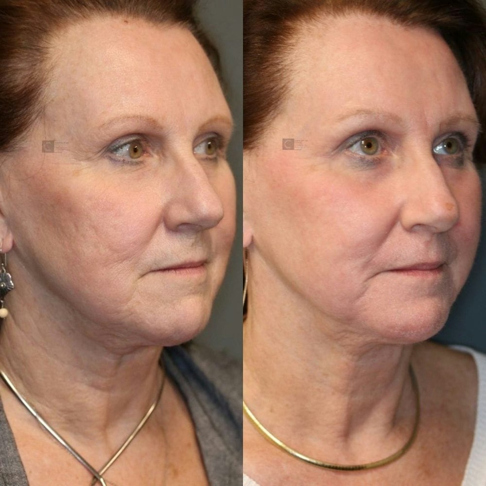 Before and After Virtuoso Lift Tightening