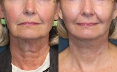 EnigmaLift - Facelift Before & After Gallery - Patient 8560387 - Image 1