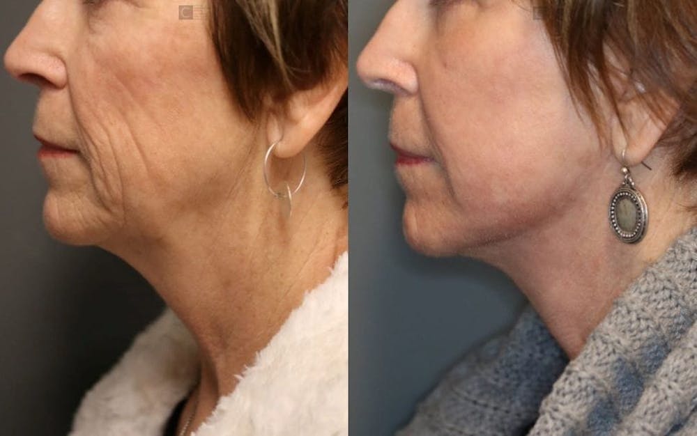 EnigmaLift - Neck Lift Before & After Gallery - Patient 8560410 - Image 1