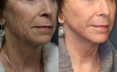 ÔPTIMized Laser Cocktail Before & After Gallery - Patient 8560426 - Image 2