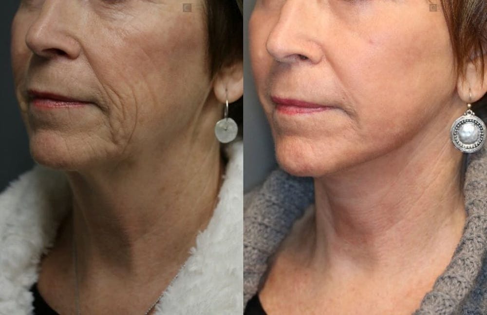 EnigmaLift - Facelift Before & After Gallery - Patient 8560403 - Image 4