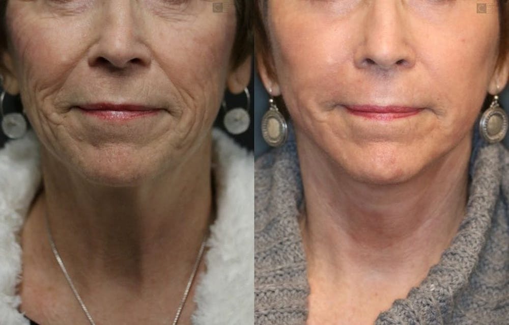 EnigmaLift - Facelift Before & After Gallery - Patient 8560403 - Image 5