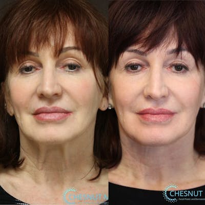 EnigmaLift - Neck Lift Before & After Gallery - Patient 8560431 - Image 1