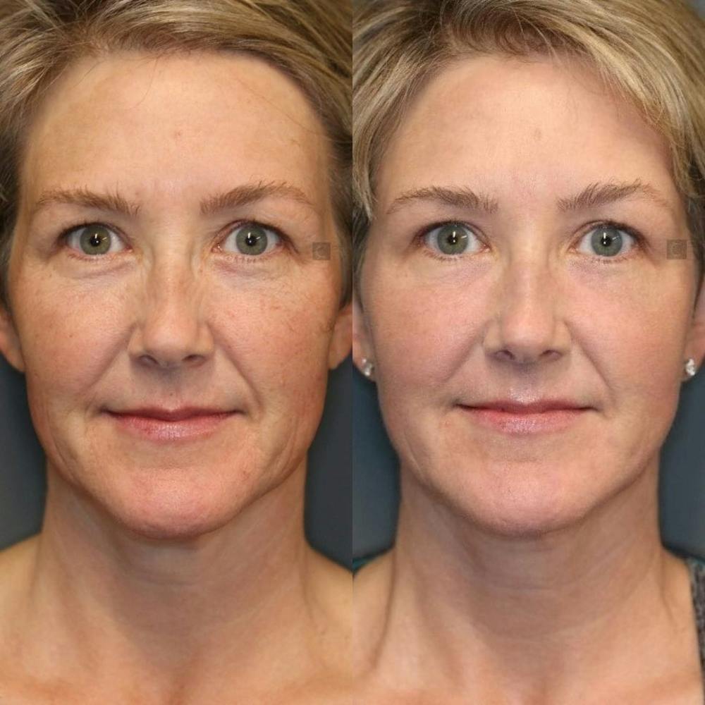 ÔPTIMized Laser Cocktail Before & After Gallery - Patient 8560434 - Image 1