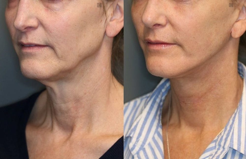 EnigmaLift - Facelift Before & After Gallery - Patient 8560435 - Image 1