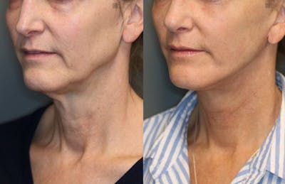 EnigmaLift - Facelift Before & After Gallery - Patient 8560435 - Image 1