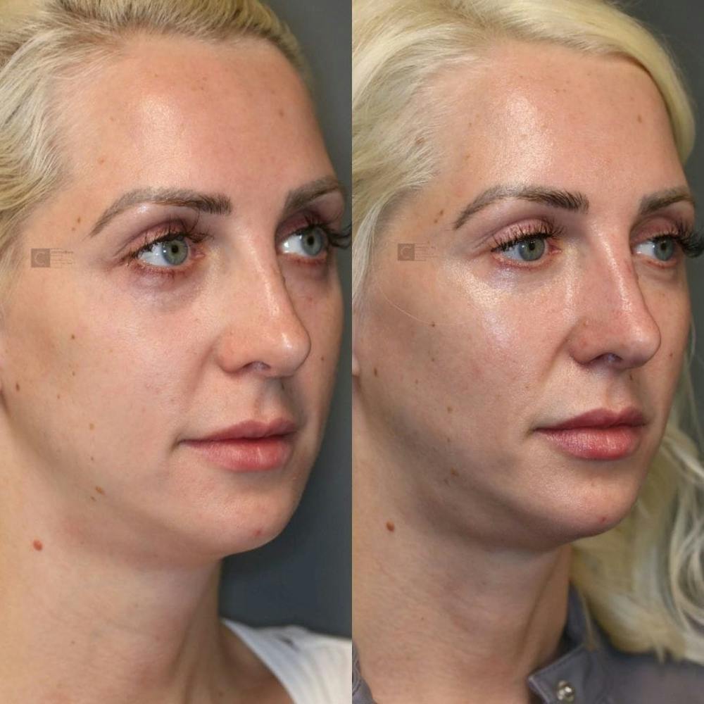 Dermal Fillers Before & After Gallery - Patient 8560443 - Image 1