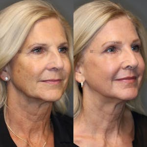 Before and after liquid facelift
