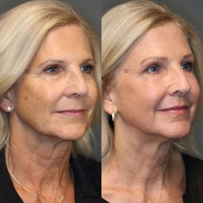 LoveLift - Lip Lift Before & After Gallery - Patient 8560496 - Image 1