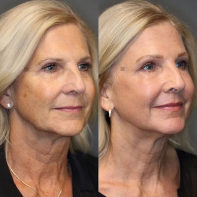 Before & After - Dermal Fillers