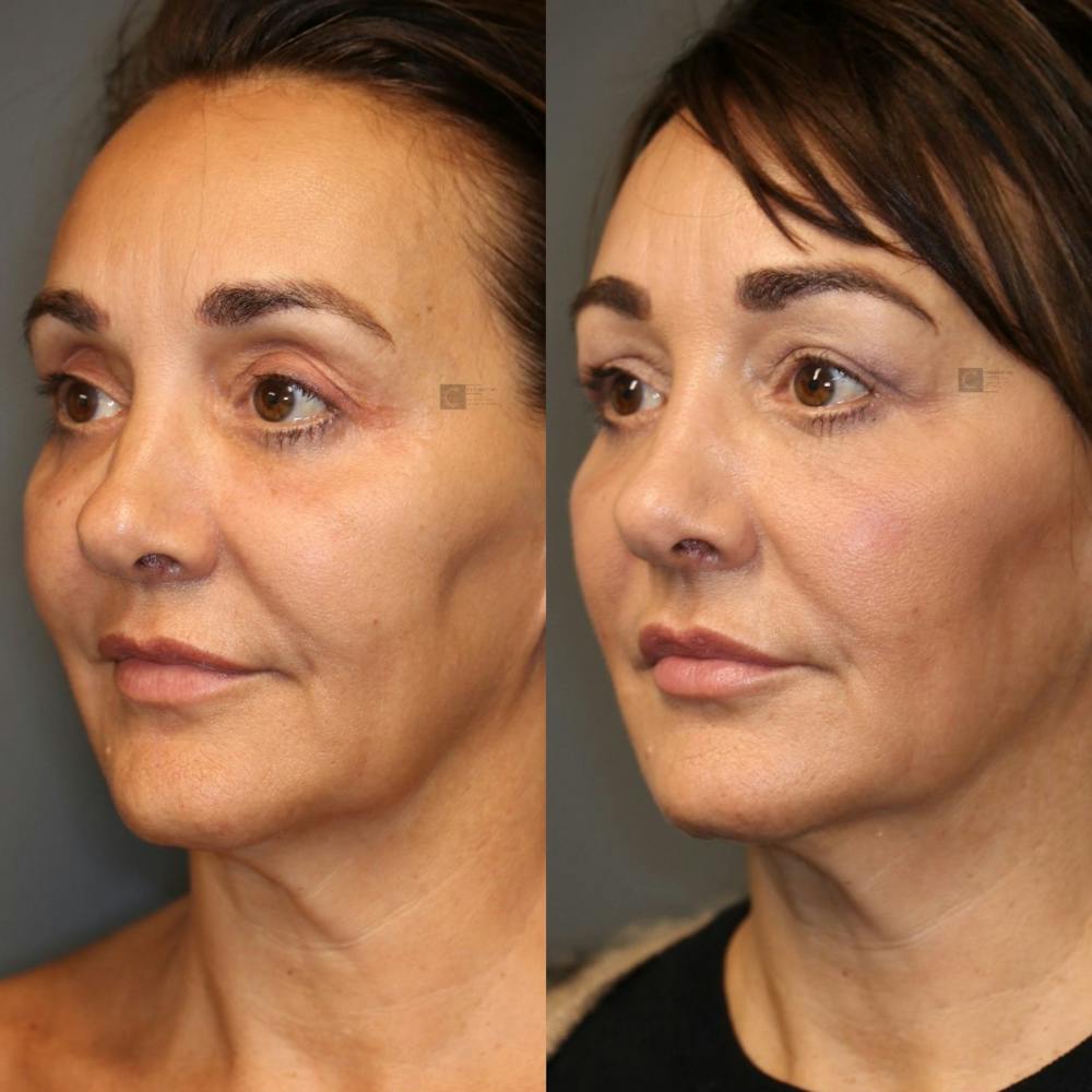 Thread Lift Before & After Gallery - Patient 8560536 - Image 1