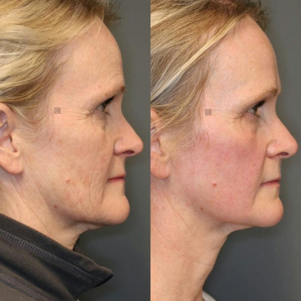 ÔPTIMized Laser Cocktail Before & After Gallery - Patient 8560556 - Image 1