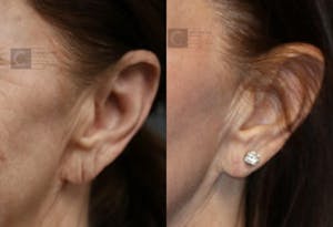 Before and After Earlobe Repair