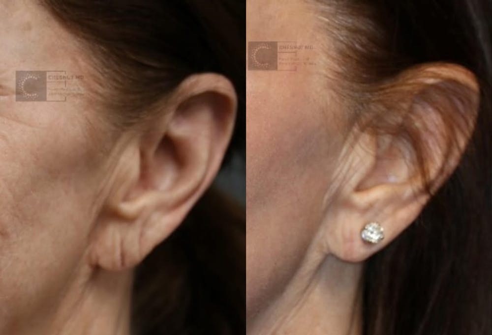EnigmaLift - Earlobe Reduction Before & After Gallery - Patient 9494213 - Image 1