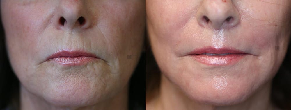 Vertical Lip Lines Before & After Gallery - Patient 9511812 - Image 1