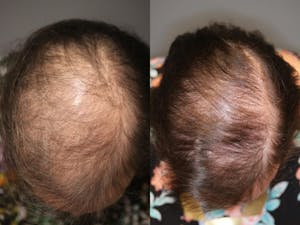 Before and after hair restoration