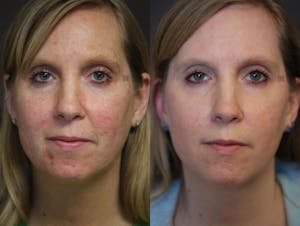 Before and after light-based acne treatment