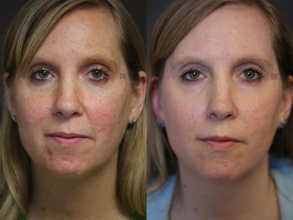 Scar Treatment Before & After Gallery - Patient 74354094 - Image 1