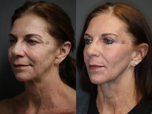Before and After Virtuoso Lift - Neck & Jawline Tightening
